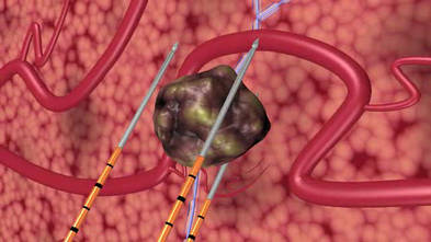 The diagram shows the insertion of three IRE probes, which are positioned around the tumour. 