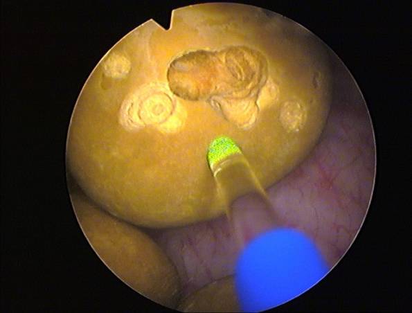 The image shows the tip of the bladder stone laser during lithotripsy; pulsed energy fragments the stone.
