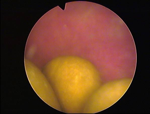The image shows three large bladder stones before treatment.