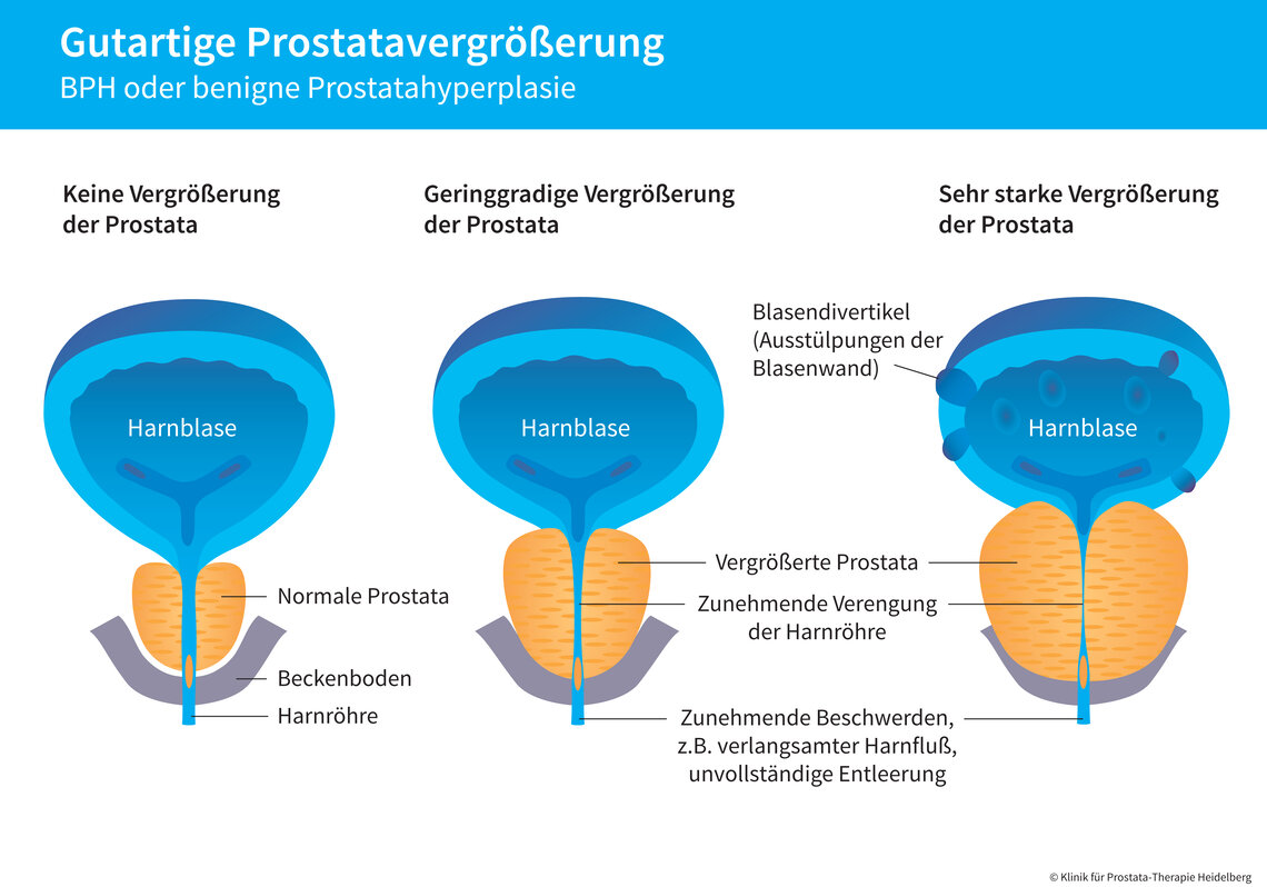 Die Grafik verdeutlicht den Zusammenhang zwischen einer vergrößerten Prostata und Störungen beim Entleeren der Blase. 
