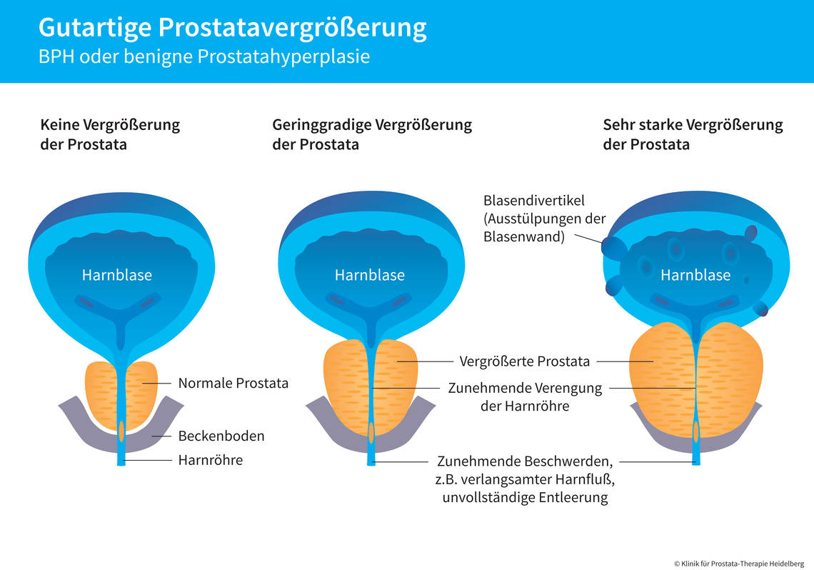 Die Grafik verdeutlicht den Zusammenhang zwischen einer vergrößerten Prostata und Störungen beim Entleeren der Blase. 