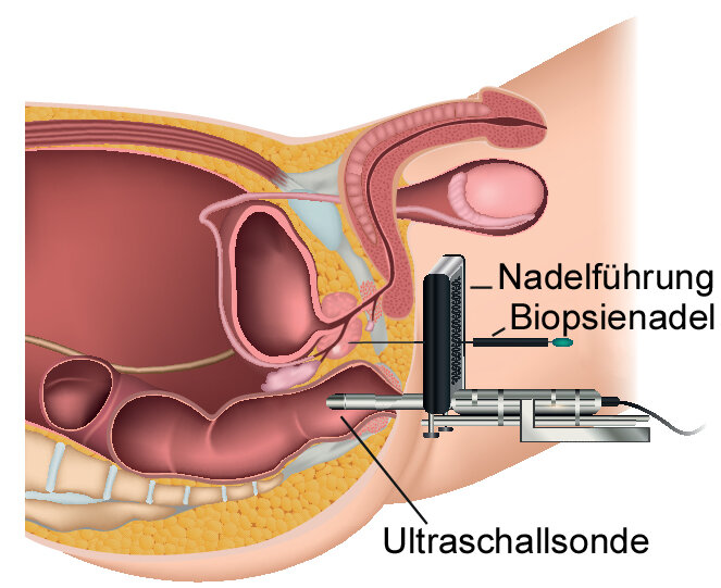 Bei erhöhtem PSA-Wert oder auffälligem Tastbefund der Prostata wird oft die histologische Abklärung des Prostatagewebes empfohlen – d.h. eine Gewebeentnahme zur weiteren Untersuchung (Biopsie).