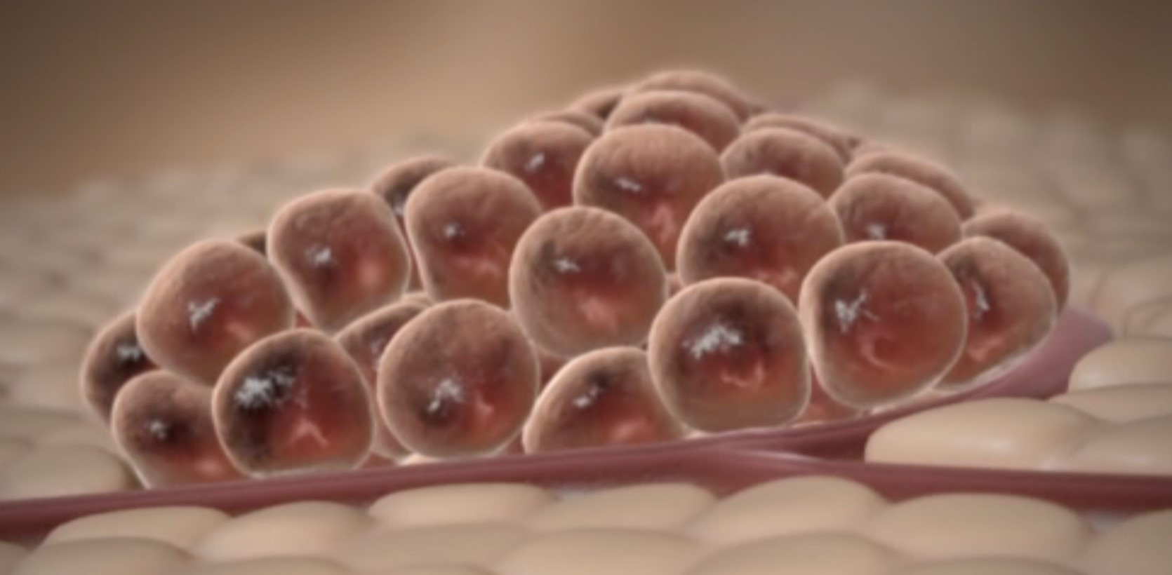 Anhäufung von Tumorzellen