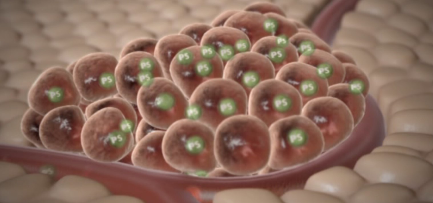 Anhäufung von Tumorzellen