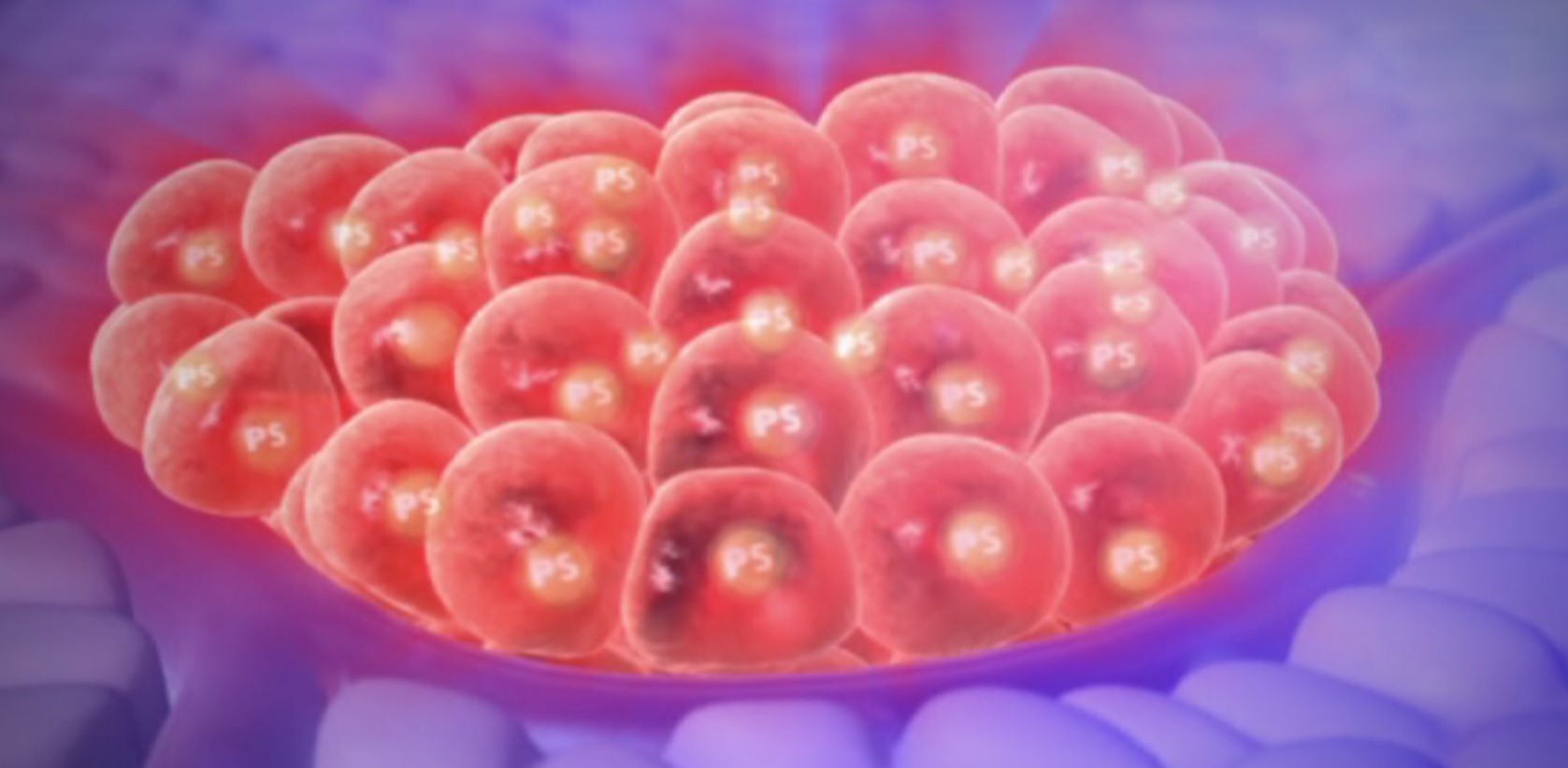 Anhäufung von Tumorzellen