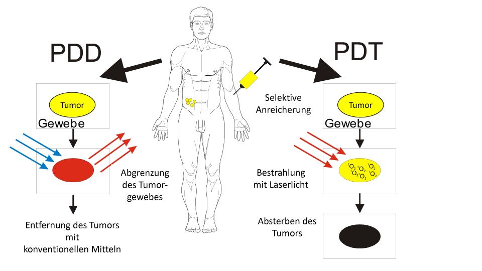 Das Wirkprinzip der Photodynamischen Therapie (PDT) 
