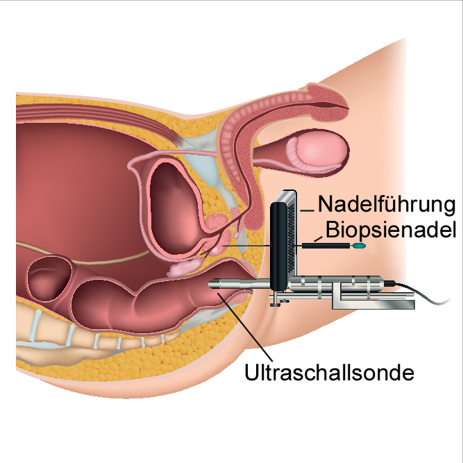 Biopsie der Prostata
